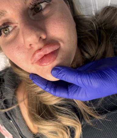 Lady after lip filler