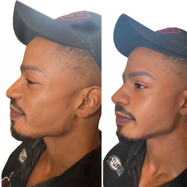 Man after jaw filler