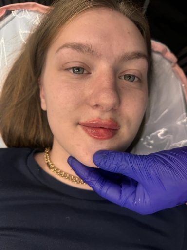A young women after lip filler