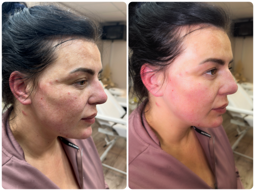 Lady after 8 point face lift/chin before and after
