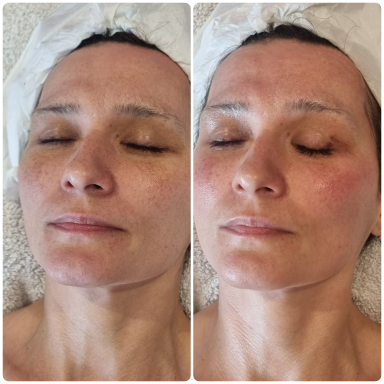 Lady after radio frequency facial