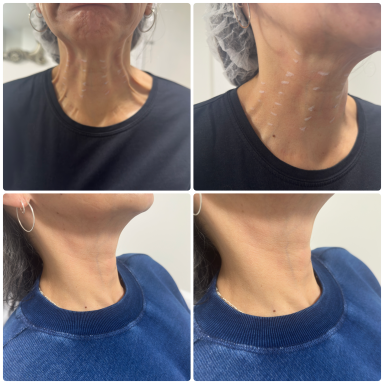 Lady after neck rejuvenation treatment